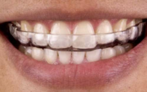Dentist-Toa-Payoh-Teeth-Ginding
